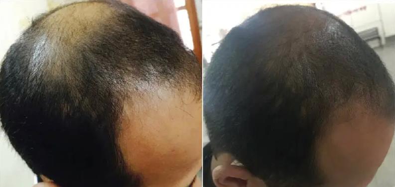 治療脫發(fā)除了植發(fā)，你還有很多選擇